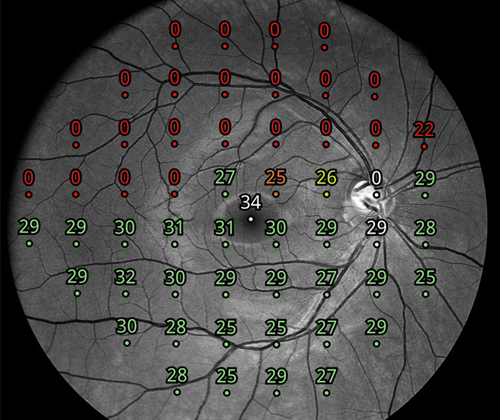Compass - Fundus Automated Perimetry
