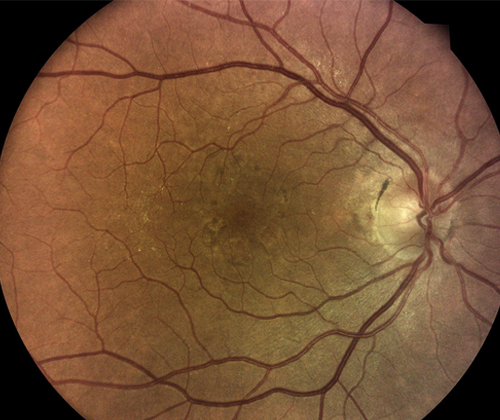 iCare EIDON widefield TrueColor