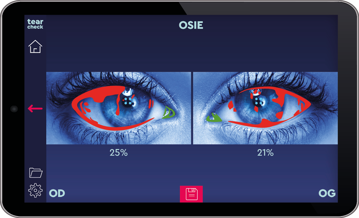 Ocular Surface Inflammatory Risk Evaluation