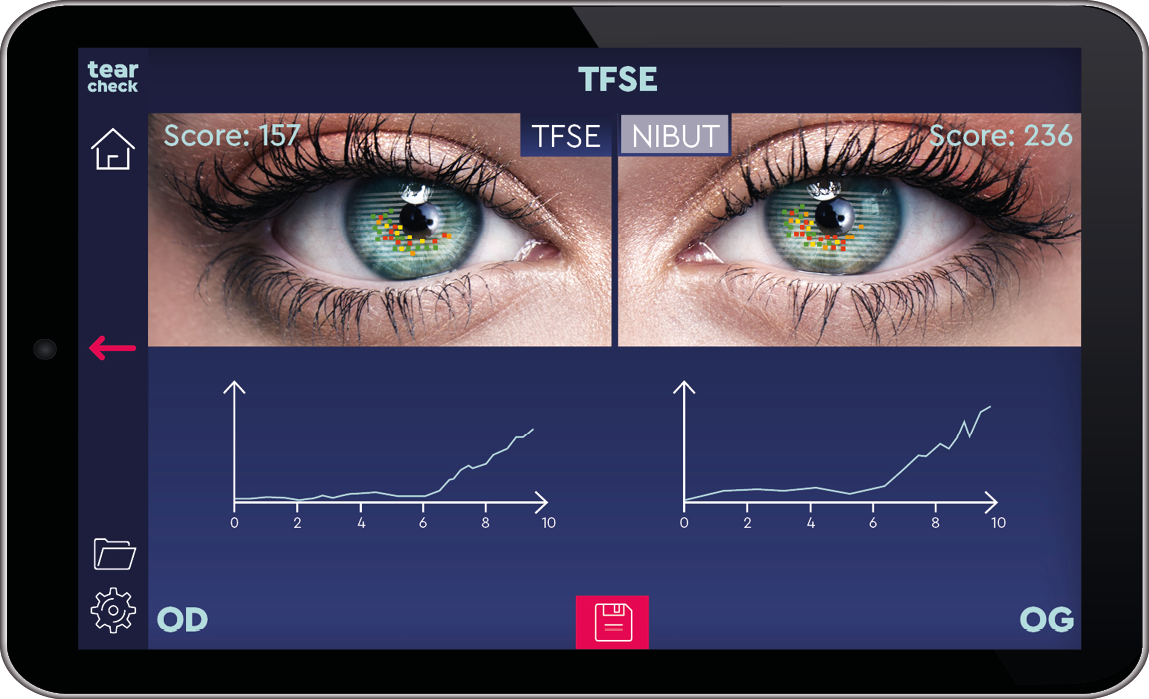 Tear Film Stability Evaluation/Non-Invasive Breakup Time