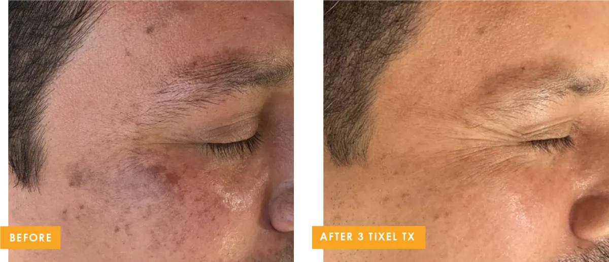 Tixel: Simple Elegance